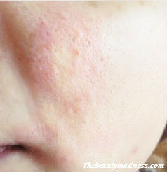 How do you prevent skin rashes?