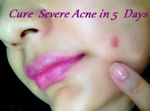 remedies to cure severe acne